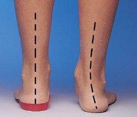 Лечение шишек на ногах в воронеже