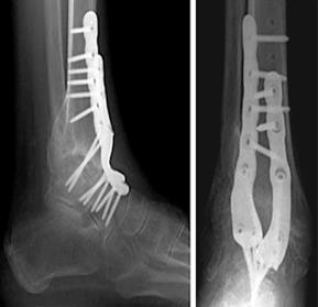Лечение косточки на ноге в воронеже