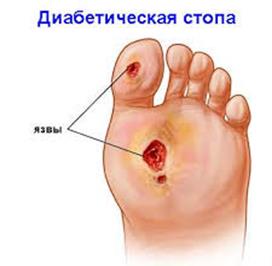 Лечение шишек на ногах в воронеже thumbnail